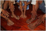 Kỳ lạ gia tộc mỗi người có 24 ngón tay, chân