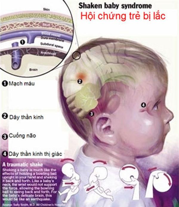  Bế trẻ không đúng cách có thể gây hội chứng rung lắc nguy hiểm  - 1