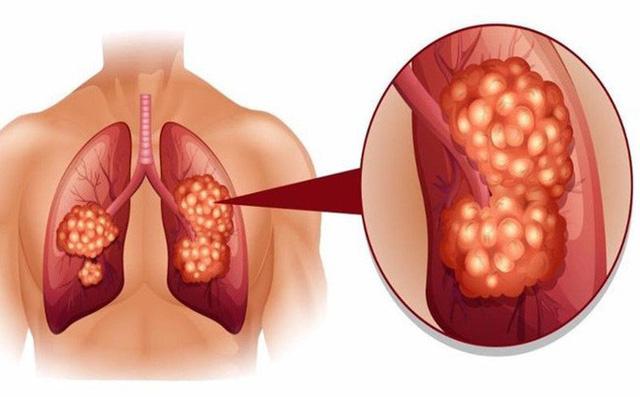 Dấu hiệu lặng lẽ của bệnh ung thư phổi không ai được xem thường - 0