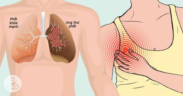 Dấu hiệu lặng lẽ của bệnh ung thư phổi không ai được xem thường - 2