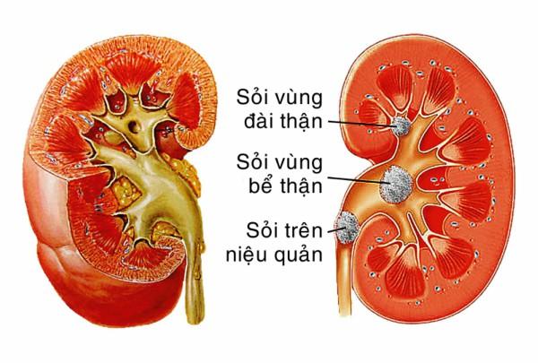 Đẩy lùi căn bệnh nhà giàu mang tên ‘Gout’ nhờ bài thuốc Đông y hữu hiệu - 1