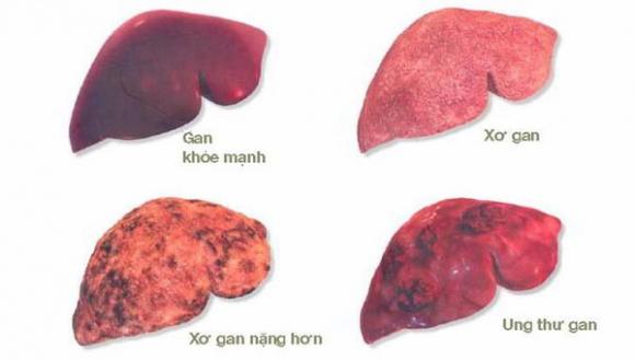 42 1 Giam Doc Bv K Huong Dan Cach Phong Benh Ung Thu Co Ty Le Mac Moi Nhieu Nhat Tai Viet Nam