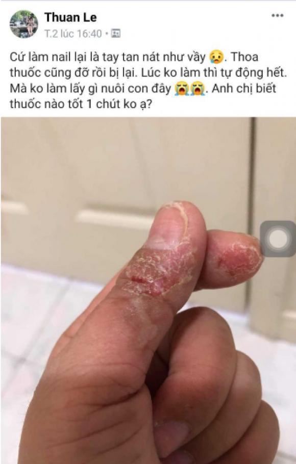 42 2 Can Canh Doi Ban Tay Nat Buom Thay Thuong Cua Cac Tho Nail