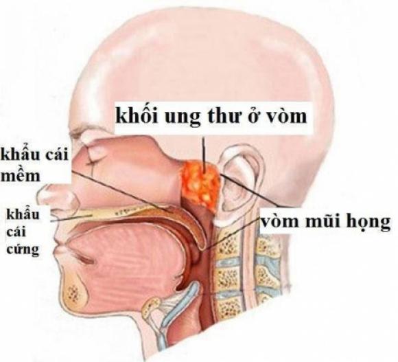 42 2 Mon Ca Nhieu Nguoi Thich Duoc Who Xep Vao Nhom Gay Ung Thu So 1 Dung An Keo Mac Benh