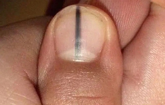 2 Son Mau Do De Che Di Mong Tay Xau Xi Nguoi Phu Nu Khong Ngo Do La Dau Hieu Ung Thu Neu Co 3 Bieu Hien Nay O Tay Can Di Kham Ngay