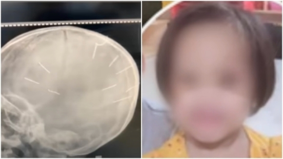 1 Be 3 Tuoi O Ha Noi Bi Gam Dinh Vao Dau Van Hon Me Sau Sau Gan Thang Dieu Tri