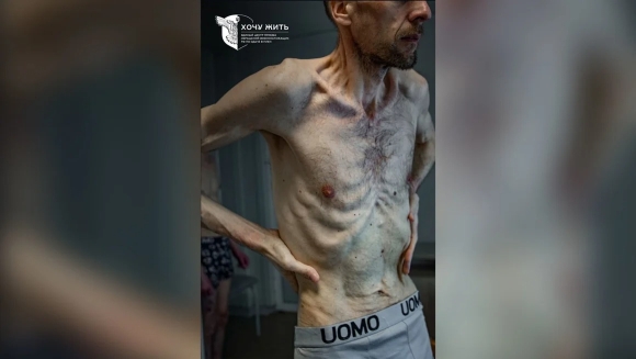 1 Ukraine Cong Bo Anh Tu Binh Da Boc Xuong Khi Duoc Nga Trao Tra