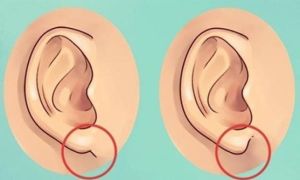  8 dấu hiệu ở tai giúp bạn chẩn đoán được bệnh trên cơ thể