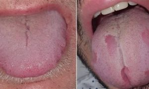 ‘Covid lưỡi‘, triệu chứng mới của đại dịch