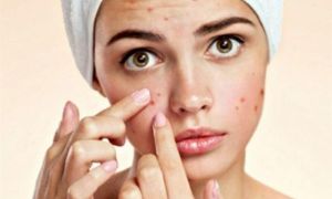 7 cách đơn giản giúp bạn ngăn ngừa mụn trên mặt