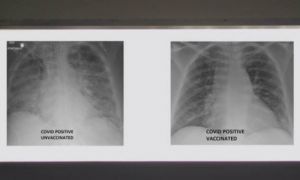 So sánh ảnh chụp phổi của bệnh nhân COVID-19 đã tiêm và chưa tiêm vaccine,...