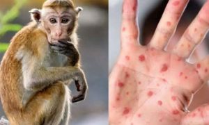 Virus đậu mùa khỉ lây lan, WHO sắp họp khẩn
