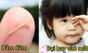 10 mẹo dân gian chữa dứt ngay bệnh vặt người Việt vẫn dùng hàng trăm năm qua