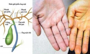 10 dấu hiệu nhắc bạn cần đi kiểm tra sức khỏe cho túi mật