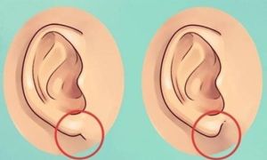 8 dấu hiệu ở tai giúp bạn chẩn đoán được bệnh trên cơ thể