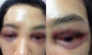 Thảm họa từ thẩm mỹ giá rẻ: Lời cảnh tỉnh cho chị em mê làm đẹp