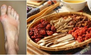 Đẩy lùi căn bệnh nhà giàu mang tên ‘Gout’ nhờ bài thuốc Đông y hữu hiệu
