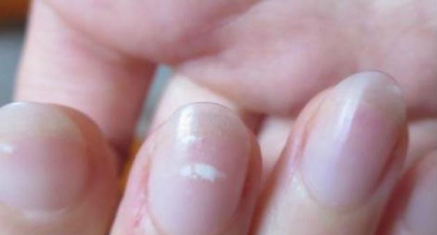 Móng tay có dấu hiệu này hãy đi khám ngay đừng chủ quan vì chắc chắn bạn sẽ...