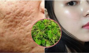 Cách trị sẹo rỗ trong vòng 1 tháng chỉ với nhúm rau rẻ tiền này! Mẹo cực hay...