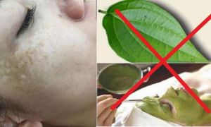 Da mặt loang lổ do đắp cao lá trầu không làm đẹp
