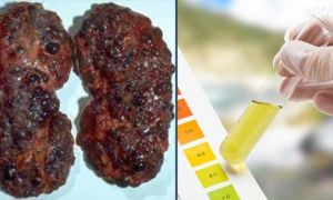 9 dấu hiệu cảnh báo chức năng thận bắt đầu suy yếu