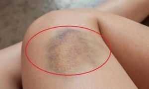 Cơ thể bỗng nhiên bầm tím, nước tiểu đục: Dấu hiệu sớm cảnh báo ung thư