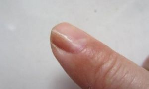 Hãy đến bác sĩ ngay nếu phát hiện móng tay có 3 dấu hiệu lạ này