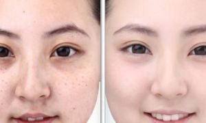 Học người xưa 6 bí quyết trị tàn nhang từ thiên nhiên ngay tại nhà