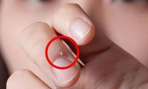 Ngón tay dễ bị hoại tử vì thói quen cắn xước măng rô