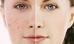 5 loại kem trị thâm sẹo, mụn, nám sẵn có ở tiệm thuốc tây