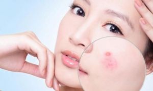 Những mẹo 'đánh bay' mụn bọc sưng đỏ trong nốt nhạc, chị em cần bỏ túi ngay...