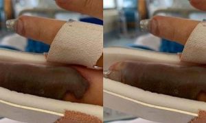 Làm nail ở tiệm quen, người phụ nữ bị hoại tử ngón tay và suýt phải cắt bỏ vì...