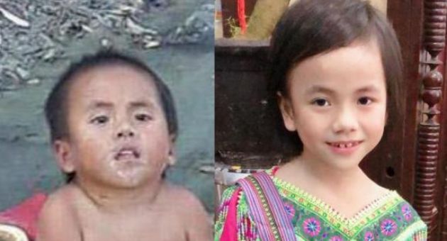 Em bé Mường Lát bị liệt 2 chân cười rạng rỡ trong hình ảnh mới nhất