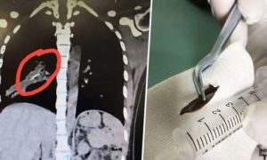 Ho suốt 14 năm chỉ vì mảnh xương gà