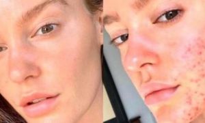 Mẫu nữ người Úc tiết lộ cách chữa hết mụn trứng cá