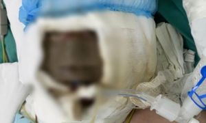 Xông lá thuốc phòng Covid-19, bé gái bỏng hết khuôn mặt