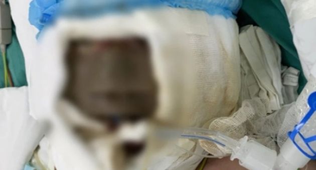 Xông lá thuốc phòng Covid-19, bé gái bỏng hết khuôn mặt
