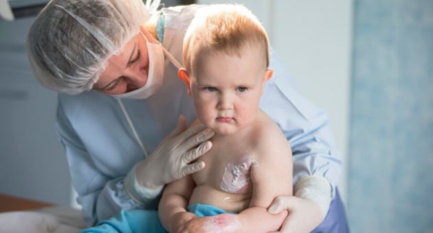Cách xử lý khi trẻ bị bỏng