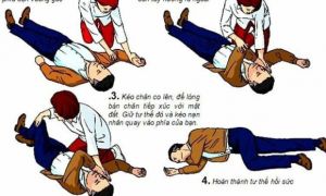Dấu hiệu đột quỵ và cách sơ cứu