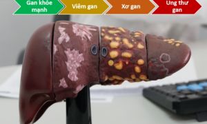 Những dấu hiệu cảnh báo đầu tiên khi mắc ung thư gan