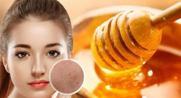4 cách đánh bay mụn, giúp da trắng sáng mịn màng từ mật ong