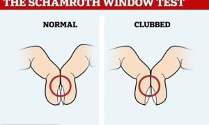 Nhìn ngón tay có thể biết bị ung thư hay không