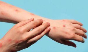 Châu Âu nâng mức cảnh báo về rủi ro đối với bệnh đậu mùa khỉ