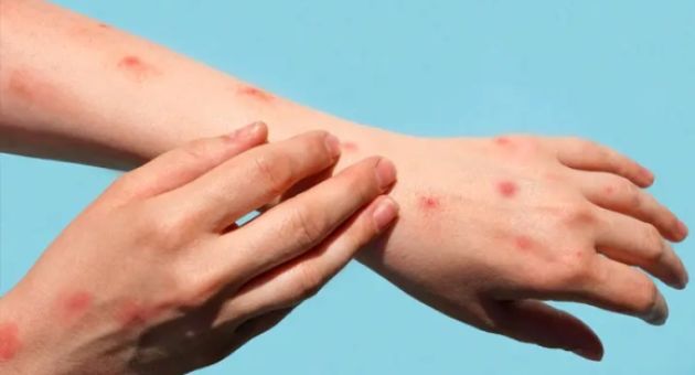 Châu Âu nâng mức cảnh báo về rủi ro đối với bệnh đậu mùa khỉ