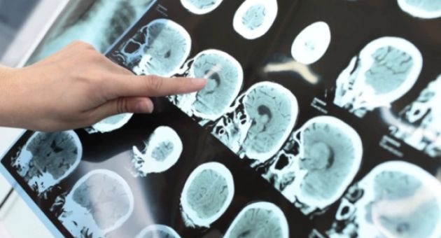 Phân biệt chóng mặt và đột quỵ